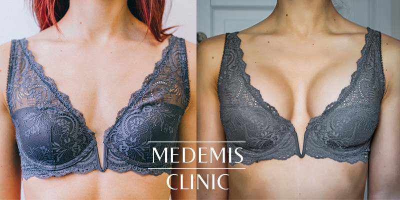 medemis_ilukirurgia_rinnad_rinnaimplantaadid_paljasporgand