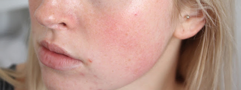 punetavate põskede ravi
